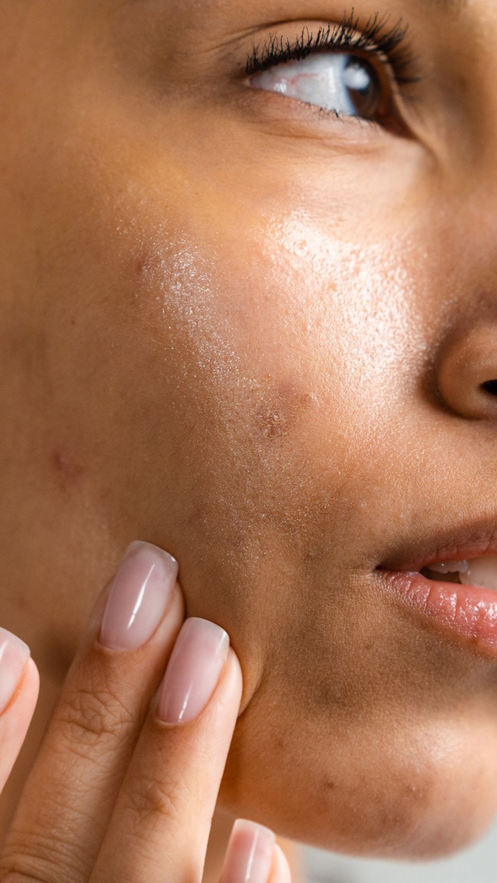 Acne-Prone Skin