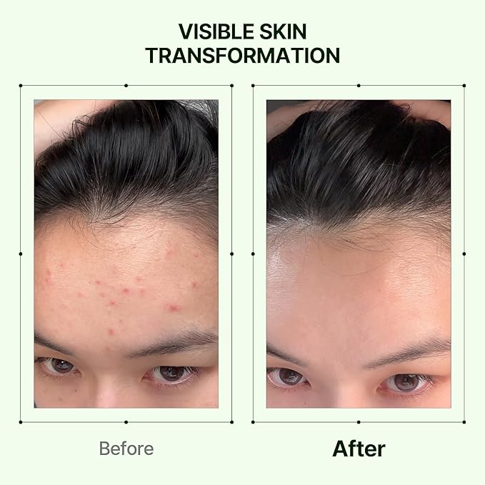 ORIEN Zero Film Toner - Clears Acne, Refines Pores & Hydrates Skin