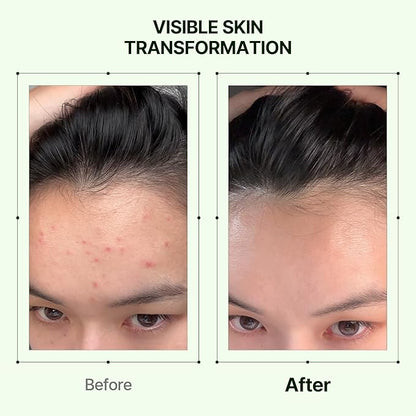ORIEN Zero Film Toner - Clears Acne, Refines Pores & Hydrates Skin